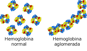 hemoglobina normal em c&eacute;lulas sangu&iacute;neas normais vermelhos e hemoglobina agregada, em forma de foice das c&eacute;lulas vermelhas do sangue